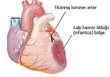 kalp krizi