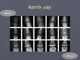 kemik yaşı