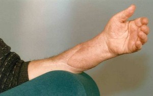 organ nakli nasıl yapılır