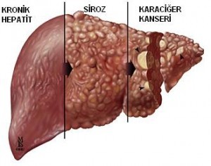 siroz-karaciğer