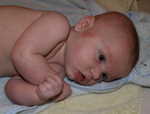 sut-protein-alerjisi