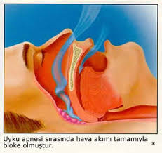 uyku apnesi