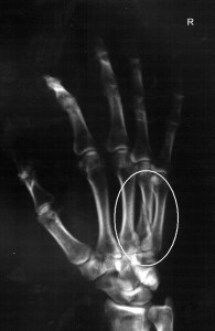 yuzuk-parmagi-kirik-kemik