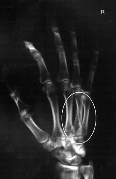 Kırık nasıl anlaşılır? – merakname